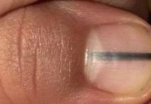 La mancha en una uña que hizo que una esteticista enviara a su cliente inmediatamente al médico