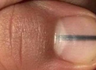 La mancha en una uña que hizo que una esteticista enviara a su cliente inmediatamente al médico