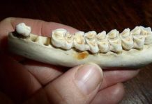 La aspirina podría reparar las caries y reducir la necesidad de empastes