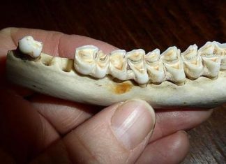 La aspirina podría reparar las caries y reducir la necesidad de empastes