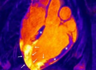 El corazón no se recupera como se pensaba tras un infarto