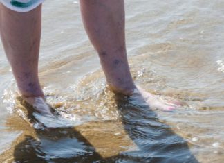 Las varices y el verano