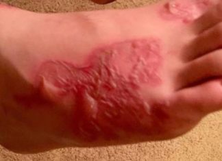 Joven contrajo una infección parasitaria tras enterrarse en una playa de Miami