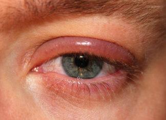 Blefaritis o inflamación del párpado: TODO lo que necesitas saber